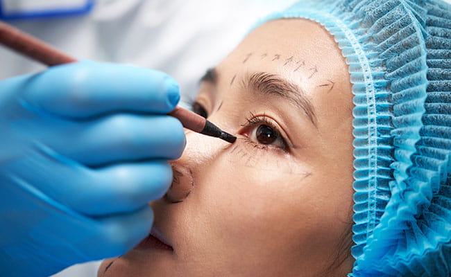 Blepharoplasty