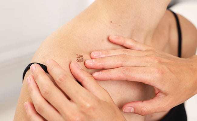 Keloid & Hypertrophic Scar Treatment