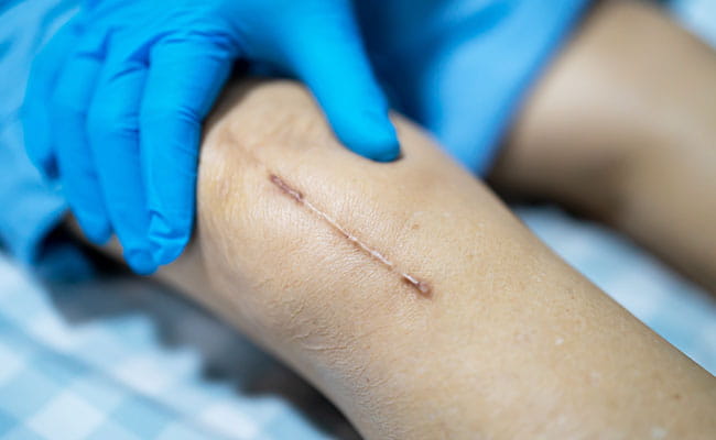 Scar Revision